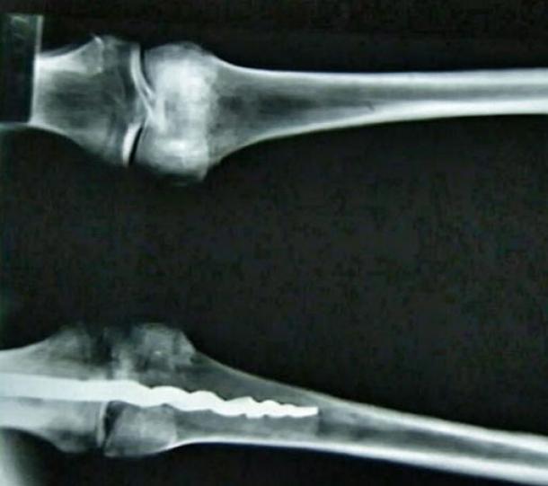 Medical Mystery of Usermontu: Why the Discovery of 2,600-Year-Old Knee Screw Left Experts Dumbfounded