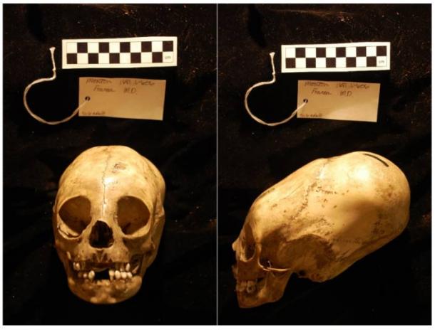 Elongated Skulls in utero: A Farewell to the Artificial Cranial Deformation Paradigm?