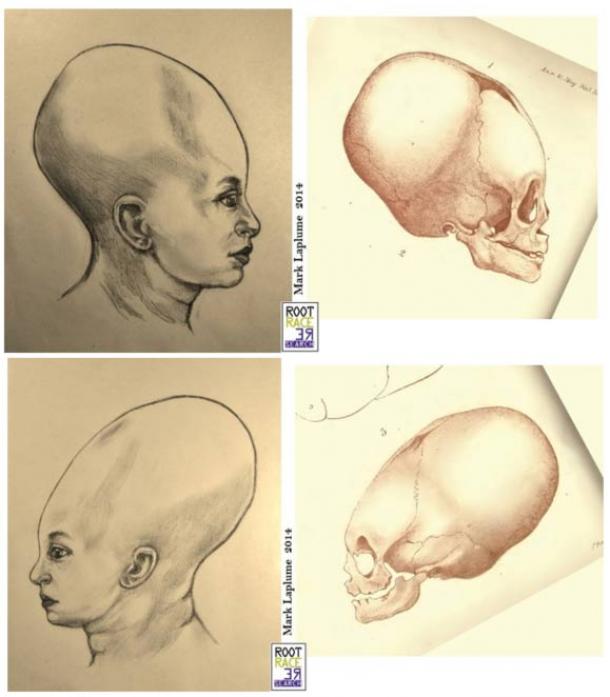 Elongated Skulls in utero: A Farewell to the Artificial Cranial Deformation Paradigm?